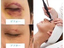 ツインズ/術後ケア2種/1.インディバ