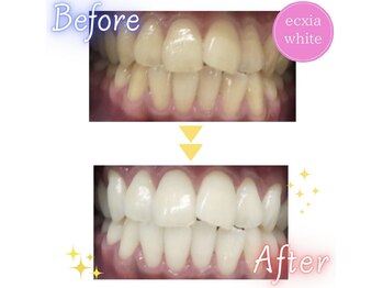 エクシアホワイト 浦安店/ホワイトニングビフォーアフター