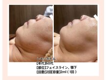 レモンボトルで瞬間小顔実感！初めての方もお気軽に♪