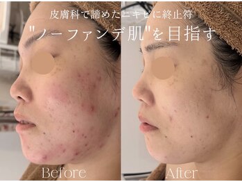 エービューティーサロン 松山店(A BEAUTY SALON.)の写真/「肌荒れ・毛穴・凹凸肌・くすみ」一気に解決！皮膚理論に基づいたエイジングマリンハーブピーリング使用。