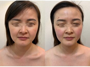 エクリア(Eclia)の写真/小顔ハイパーナイフ×コルギでマシンとハンドの相乗効果◎お顔周りの落ちにくいお肉や二重顎にも効果有◎