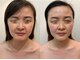 エクリア(Eclia)の写真/小顔ハイパーナイフ×コルギでマシンとハンドの相乗効果◎お顔周りの落ちにくいお肉や二重顎にも効果有◎