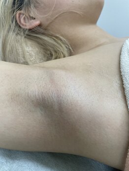 ナノハナ/鹿沼市の全身脱毛のナノハナ