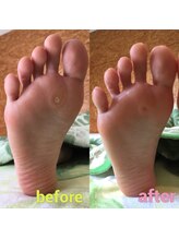 ニコルル 高崎パルクハナミズキ店(Nicolulu)/魚の目！繰り返さない足へ