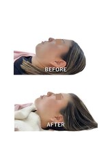 カノア(KANOA)/お顔のぽにょ取り