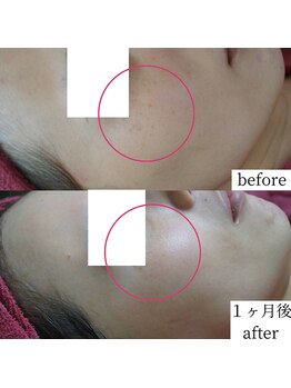 アップルミント/＜フェイシャル＞before・after