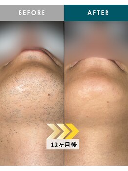 モモナ(Momona)/佐世保/脱毛/髭脱毛/全身脱毛