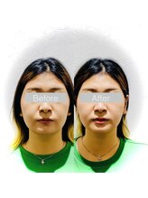 ワカヤマ 小顔(Wakayama)/☆Before・After☆