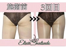 エリクシア 松戸/20代痩身太もも集中