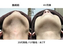 サロンアメリ イオンモール綾川店(Salon Ameri)/香川　メンズ脱毛　ヒゲ脱毛