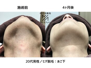 サロンアメリ イオンモール綾川店(Salon Ameri)/香川　メンズ脱毛　ヒゲ脱毛