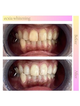 エクシア ホワイトニング 鶴岡店/ビフォーアフター