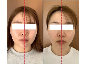 ビューティフルムーン(Beautiful Moon)/小顔矯正&小顔デザイン