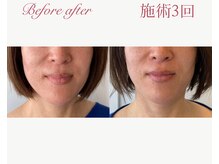 パルタージュ 三宮(Partage)/リフトアップ体感