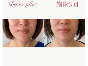 パルタージュ 三宮(Partage)/リフトアップ体感