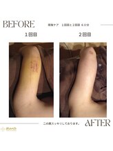 グランツ 小山店/術後ケア１回目と２回目の比較