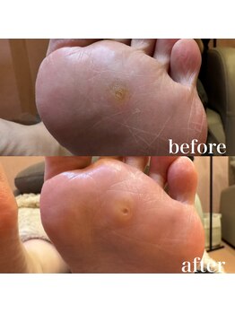 ドクターネイル爪革命 札幌大通店/症例紹介　たこ・魚の目