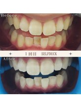 セルフダック 京都長岡京店/◇ホワイトニングの症例写真９