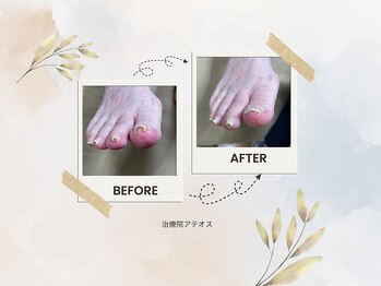 【痩身/ダイエット/整体/骨盤矯正】専門サロン アテオス/巻き爪