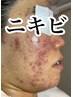 【お試しハーブピーリング】剥離有り・無し選べる体験（45分）★通常16,000↓