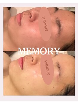 メモリー(MEMORY)/ニキビ、毛穴もない肌へ！