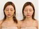 アリリィ(ARILY)の写真/厳選マシン×経験豊富なスタッフによる術前術後ケアのインディバ施術☆月通いのサブスクメニューもご用意◎