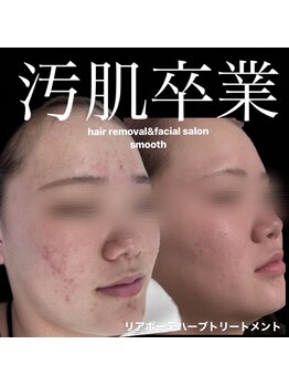 スムース(smooth)/繰り返すニキビケアはsmoothに