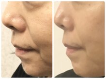 ラウン 京都(ROUN')/8回の施術ビフォーアフター