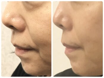 ラウン 京都(ROUN')/8回の施術ビフォーアフター