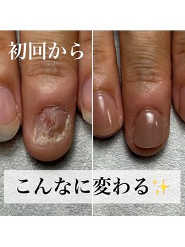 深刻な深爪も見た目改善できます