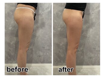 サロン ラズリ 久留米店(SALON Lazuli)/【1回施術】筋膜リリース痩身