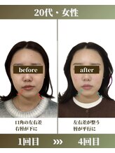 けいのき鍼灸整骨院/顔の左右差1ヵ月の変化!小顔矯正