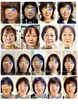 ピーチ鍼灸整体治療院(Peach鍼灸整体治療院)/美容鍼/効果絶対♪/コラーゲン♪