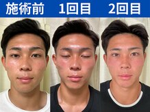 ナチュラルパーフェクトフェイス 新宿/初回～2回目