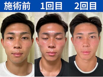 ナチュラルパーフェクトフェイス 新宿/初回~2回目