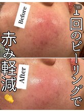 エヌプラス(N+)/30代女性＊ピーリング直後