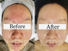 アイリー(IRIE)の雰囲気（ニキビ肌質改善はアイリーにお任せ下さい★）