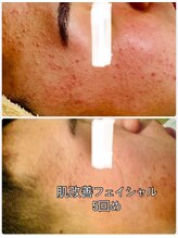 ジュエルビューティー(Jewel Beauty)/本気の肌改善　ニキビ