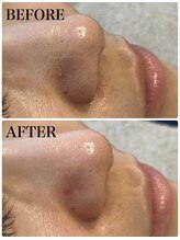 アンドエルビオ(&Elbio)/毛穴洗浄