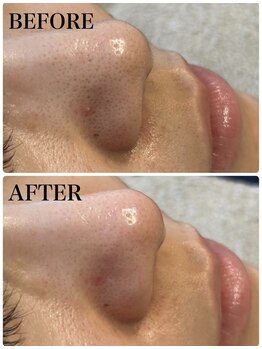 アンドエルビオ(&Elbio)/毛穴洗浄