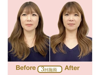 アニュームーン 草津エイスクエア店(aNewMoon)/小顔矯正ビフォーアフター