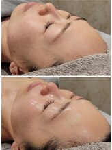 ソアラオーガニック(soara organic)/ハーブピーリングで剥き卵肌に