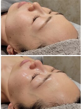 ソアラオーガニック(soara organic)/ハーブピーリングで剥き卵肌に