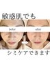 【シミ改善&ツヤ肌】濃い&薄いシミ改善◎シミケア10分当て放題　8800