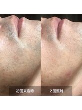 リムル(REMURU)/ひげ脱毛2回照射