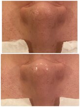 うつくし痩身 美サロン ゼットワン(Z-ONE)/ハイドロスプラッシュ1回