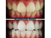 ホワイトニングショップ 鳥取店/ホワイトニングビフォーアフター