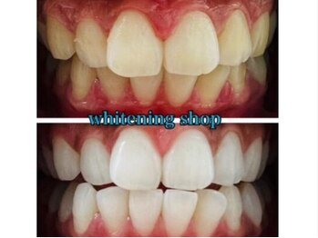 ホワイトニングショップ 鳥取店/ホワイトニングビフォーアフター