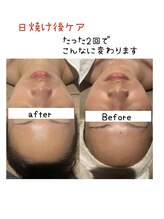 インチャント(enchant)/日焼けケア