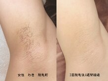 ニカ(NIKA)/ワキ専用の美肌メニュー登場！